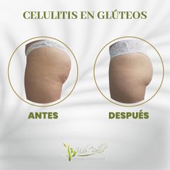 Celulitis - Vida Bella