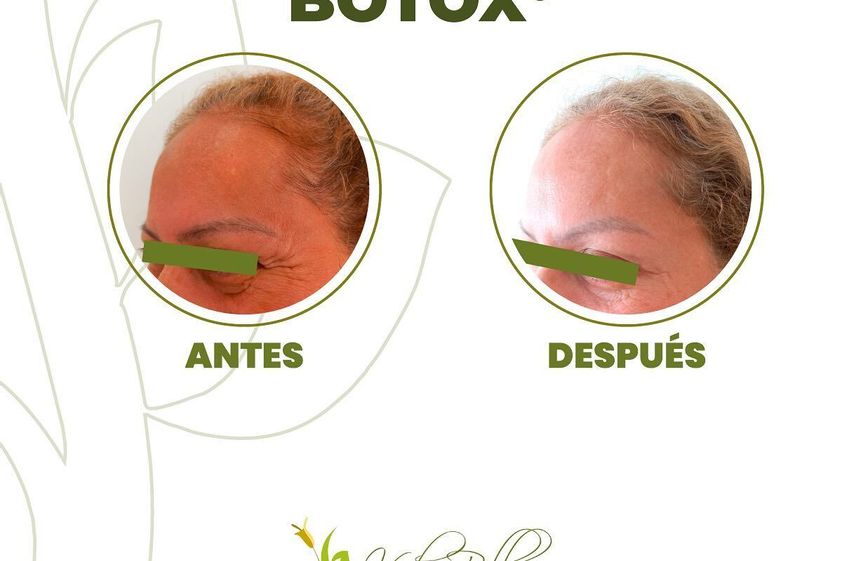 Bótox antes y después - 827587