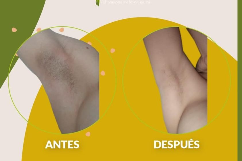 Depilación Láser antes y después - 830225