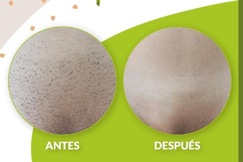 Depilación Láser antes y después - 830226