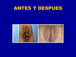 Labioplastia - Dr. Carlos Eugenio Paternina Vivero