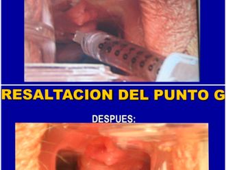 Vaginoplastia antes y después - 811670