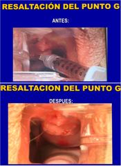 Resaltación del punto G - Dr. Carlos Eugenio Paternina Vivero