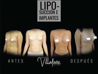 Liposucción e implantes mamarios
