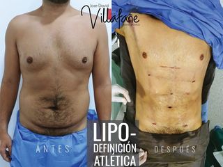 LIPODEFINICIÓN ATLÉTICA EN HOMBRES