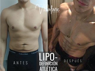 LIPODEFINICIÓN ATLÉTICA EN HOMBRES