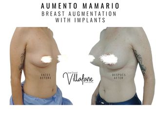 Aumento Mamario