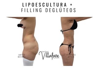 Lipoescultura