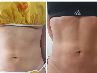 Flacidez y Fibrosis con Venus Legacy