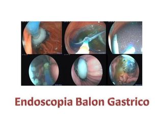 Endoscopia Balón Gástrico 