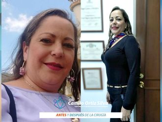 Bypass Gástrico antes y después - 813947