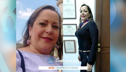 Bypass Gástrico - Dr. Camilo Ortiz Silva- Cirugía Laparoscópica Avanzada