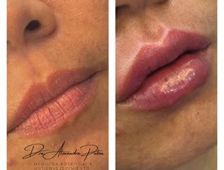 Aumento de labios - Dra. Alexandra Pabón Manrique