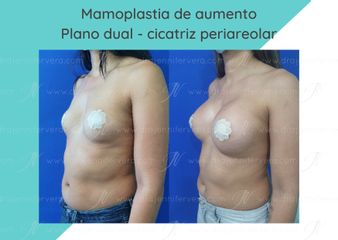 Mamoplastia de aumento - Dra. Jennifer Vera Bolívar