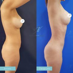 Liposucción - Dra. Jennifer Vera Bolívar