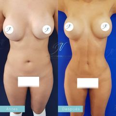 Liposucción - Dra. Jennifer Vera Bolívar
