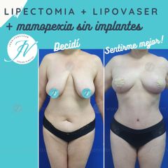 Lipoescultura - Dra. Jennifer Vera Bolívar