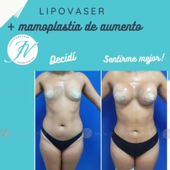 Lipoescultura - Dra. Jennifer Vera Bolívar