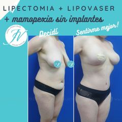 Lipoescultura - Dra. Jennifer Vera Bolívar