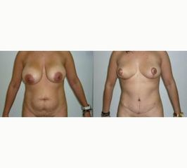Abdominoplastia - Dr. William Echeverry Duran
