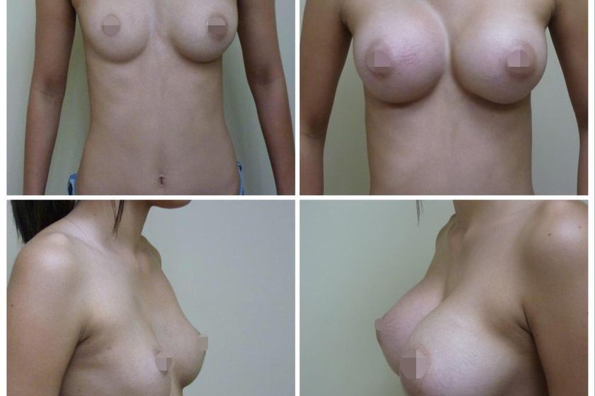 Mamoplastia de aumento antes y después - 662181