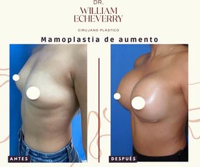 Mamoplastia de aumento - Dr. William Echeverry Duran