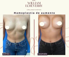 Mamoplastia de aumento - Dr. William Echeverry Duran