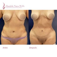Liposucción - Dra. Daniela Stephania Vaca Grisales