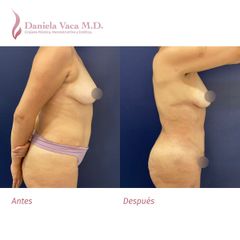 Liposucción - Dra. Daniela Stephania Vaca Grisales
