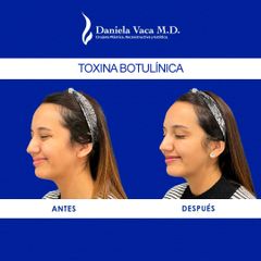 Toxina botulínica - Dra. Daniela Stephania Vaca Grisales