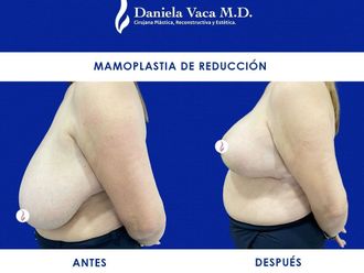 Mamoplastia de reducción - 815018