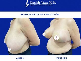 Mamoplastia de reducción - 815020