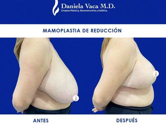 Mamoplastia de reducción - 815021