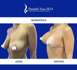 Mamopexia - Dra. Daniela Stephania Vaca Grisales