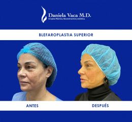 Blefaroplastia - Dra. Daniela Stephania Vaca Grisales