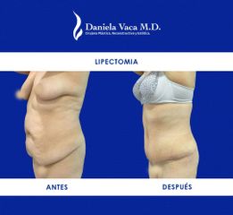 Lipectomía - Dra. Daniela Stephania Vaca Grisales