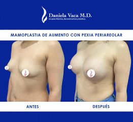 Mamoplastia de aumento - Dra. Daniela Stephania Vaca Grisales