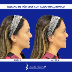 Ácido hialurónico - Dra. Daniela Stephania Vaca Grisales