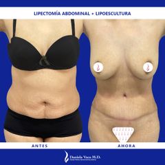 Abdominoplastia - Dra. Daniela Stephania Vaca Grisales