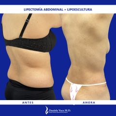 Abdominoplastia - Dra. Daniela Stephania Vaca Grisales