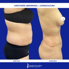 Abdominoplastia - Dra. Daniela Stephania Vaca Grisales