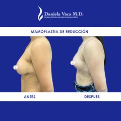 Mamoplastia de reducción - Dra. Daniela Stephania Vaca Grisales