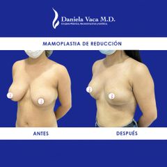 Mamoplastia de reducción - Dra. Daniela Stephania Vaca Grisales