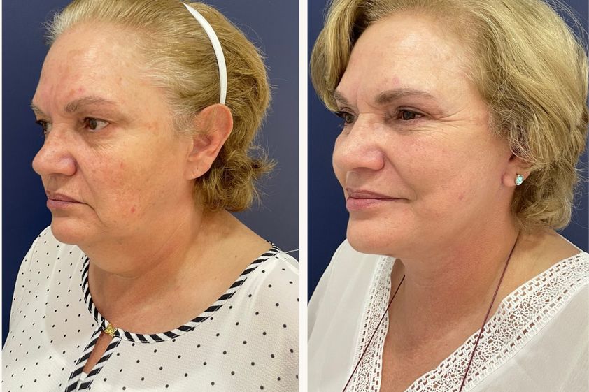 Lifting facial antes y después - 865925