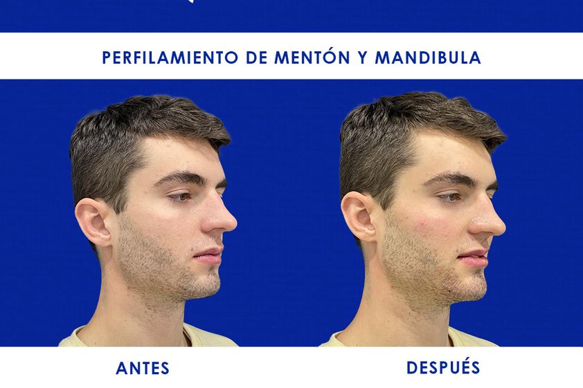 Mentoplastia antes y después - 866210