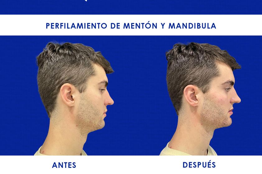 Mentoplastia antes y después - 866212