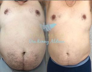 Tratamiento para adelgazar - Dra. Konny Aldana