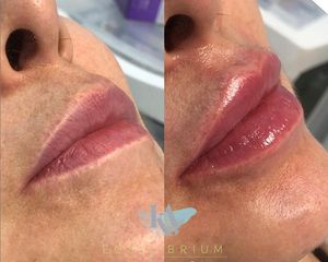 Aumento de labios - Dra. Konny Aldana