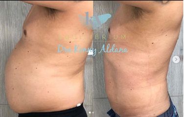Tratamiento para adelgazar - Dra. Konny Aldana