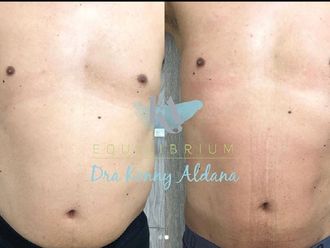 Mesoterapia antes y después - 792103